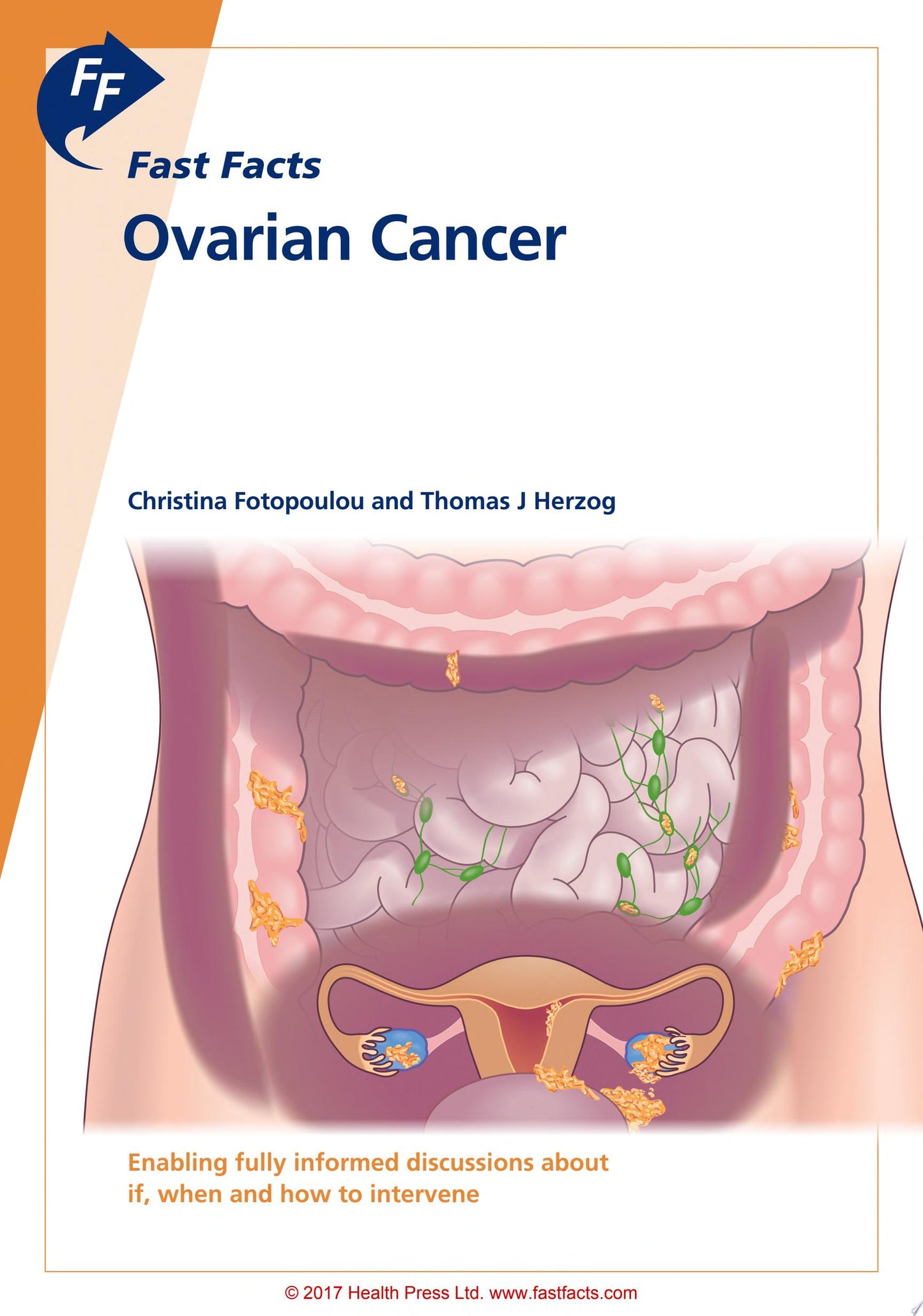 Fast Facts: Ovarian Cancer