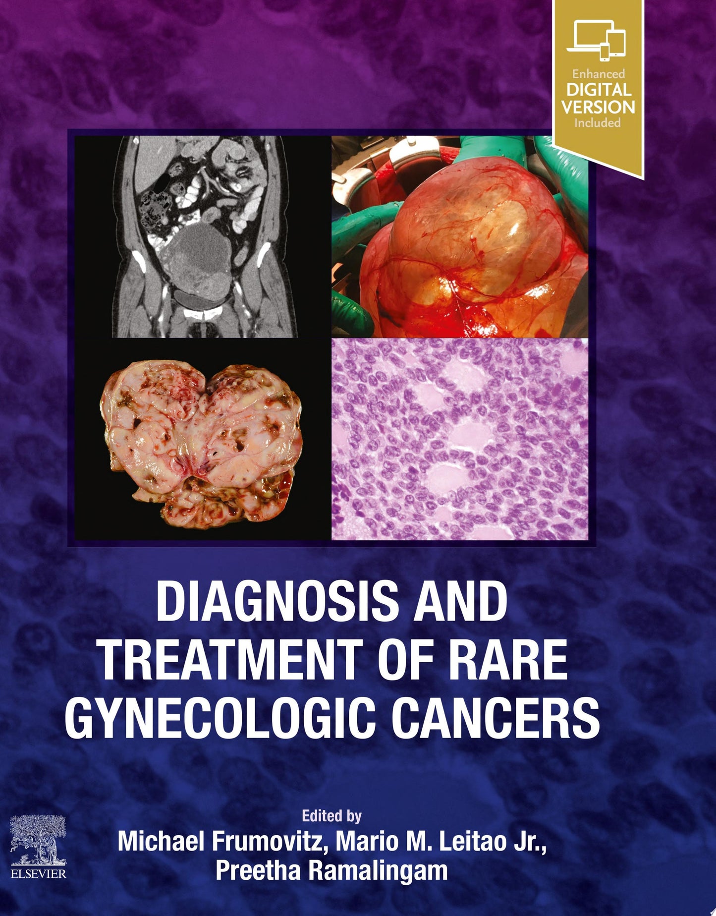 Diagnosis and Treatment of Rare Gynecologic Cancers