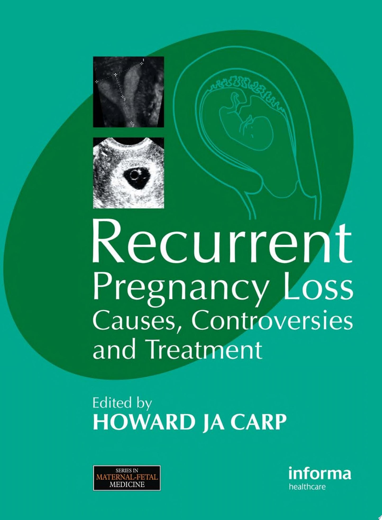 Recurrent Pregnancy Loss: Causes, Controversies and Treatment 3e