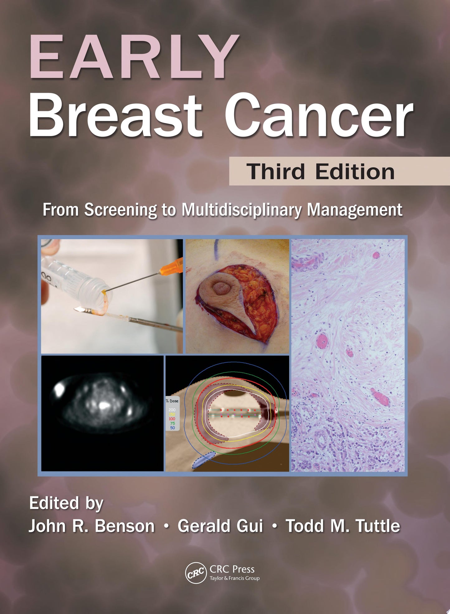 Early Breast Cancer: From Screening to Multidisciplinary Management, Third Edition